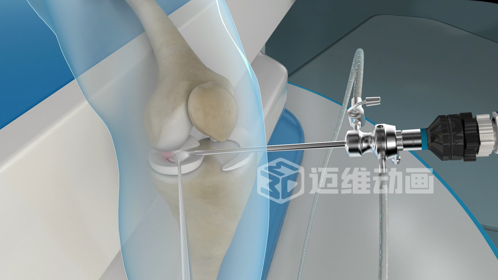 醫(yī)療器械三維動(dòng)畫：打開精準(zhǔn)傳播與高效溝通的新大門(圖4)